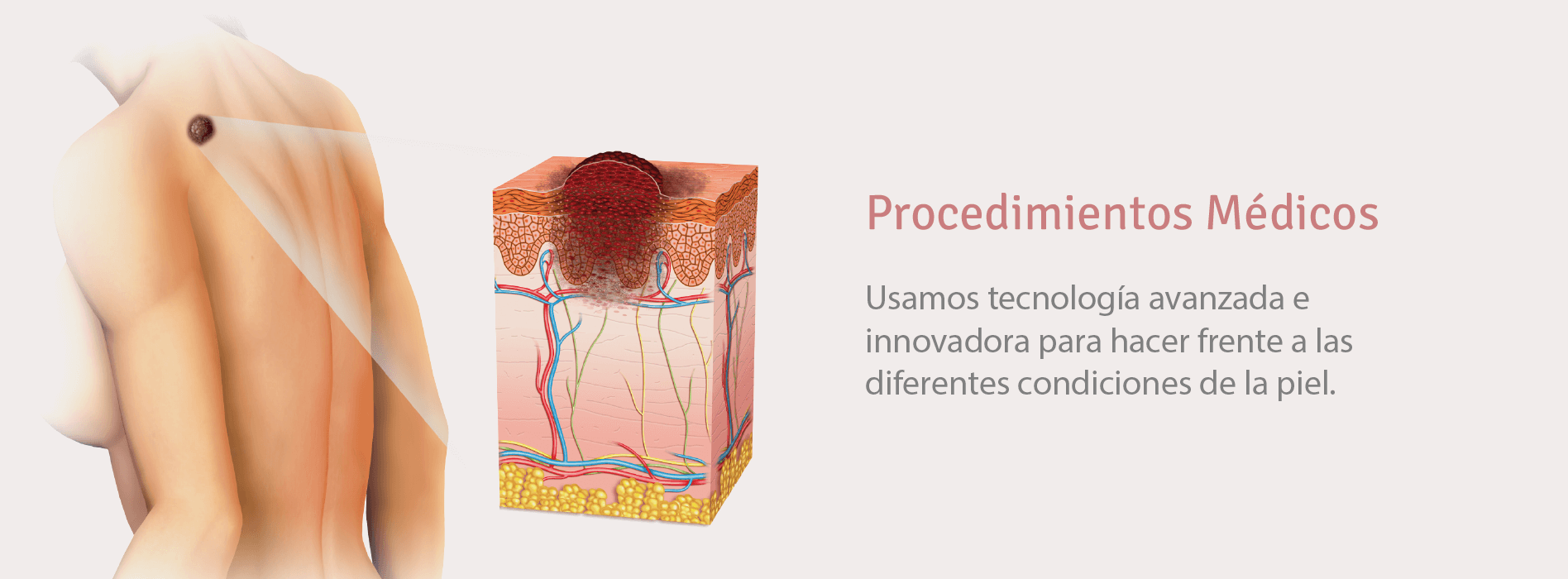 procedimientos medicos dermatologia crioterapia cauterizacion medellin